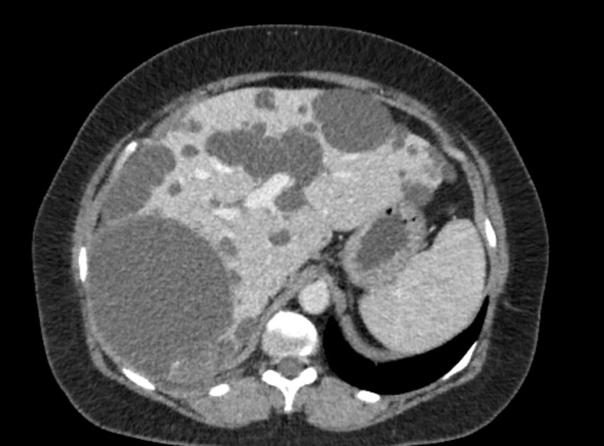 Autosomal dominant polycystic kidney disease (Radiopaedia 57124-64017 A 33).jpg