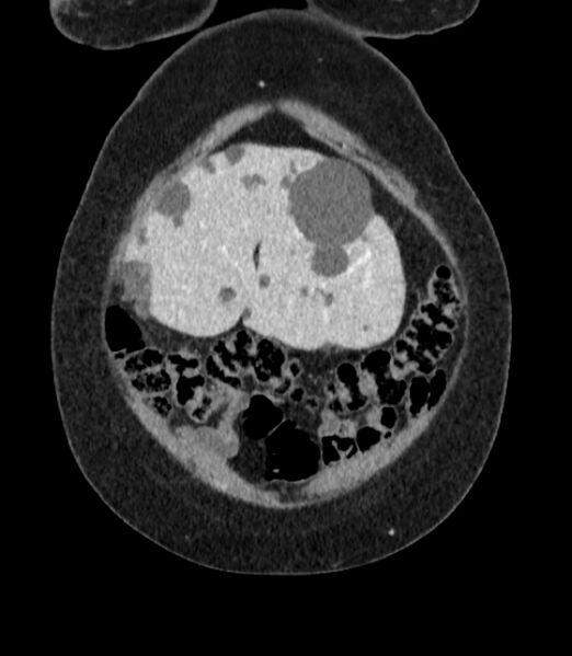 File:Autosomal dominant polycystic kidney disease (Radiopaedia 57124-64017 B 9).jpg
