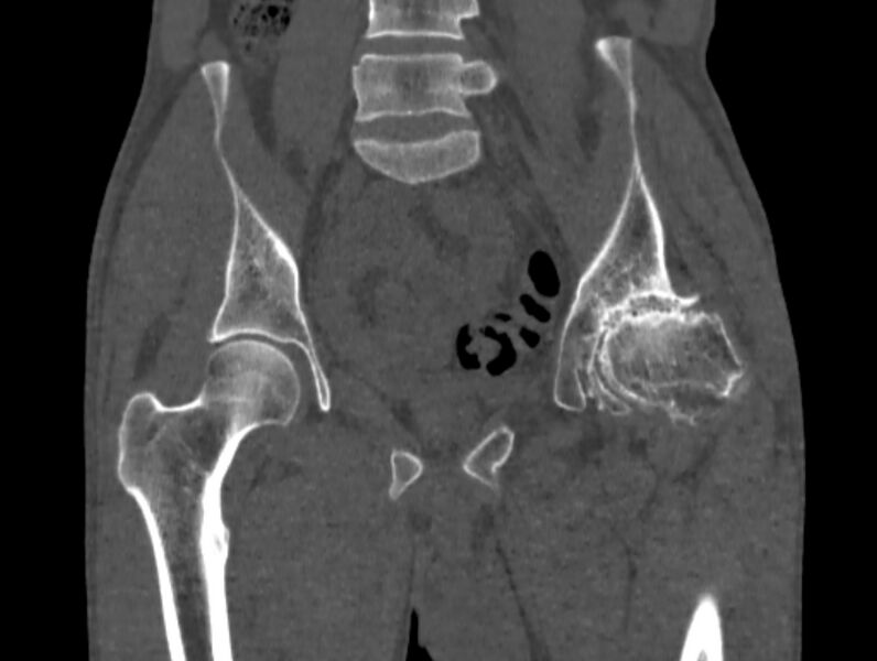 File:Avascular necrosis of the left hip (Radiopaedia 75068-86125 Coronal bone window 29).jpg