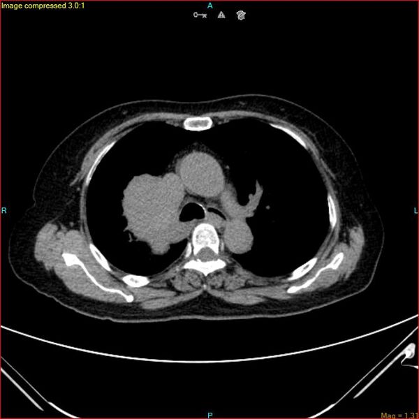 File:Azygos vein aneurysm (Radiopaedia 77824-90130 A 23).jpg