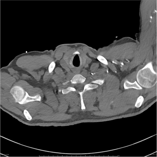 File:Azygos venous system anatomy (CT pulmonary angiography) (Radiopaedia 25928-26077 Axial C+ CTPA 1).jpg