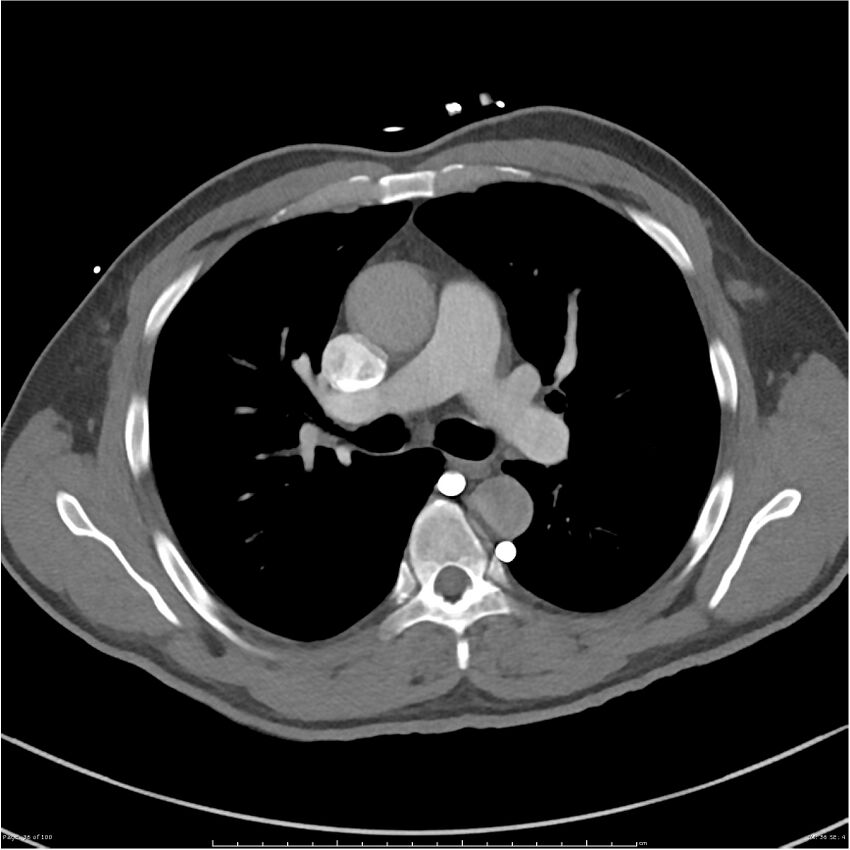 Azygos venous system anatomy (CT pulmonary angiography) (Radiopaedia 25928-26077 Axial C+ CTPA 36).jpg