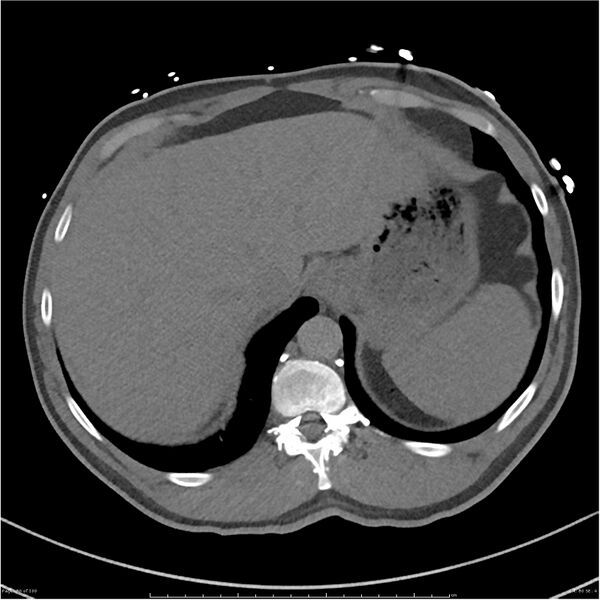 File:Azygos venous system anatomy (CT pulmonary angiography) (Radiopaedia 25928-26077 Axial C+ CTPA 80).jpg