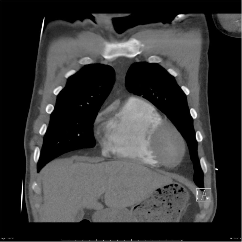 Azygos venous system anatomy (CT pulmonary angiography) (Radiopaedia 25928-26077 Coronal C+ CTPA 17).jpg