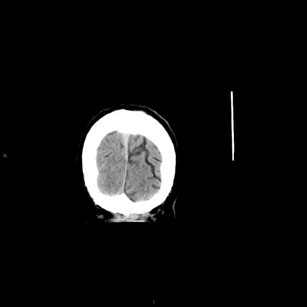 File:Basal ganglia hemorrhage (Radiopaedia 58348-65471 Coronal non-contrast 10).jpg