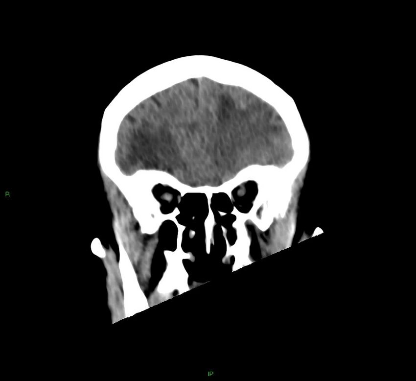Basal ganglia hemorrhage (Radiopaedia 58766-65988 Coronal non-contrast 50).jpg