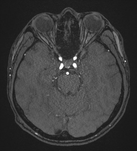 File:Basal ganglia subacute infarct (Radiopaedia 80201-93521 Axial MRA 42).png