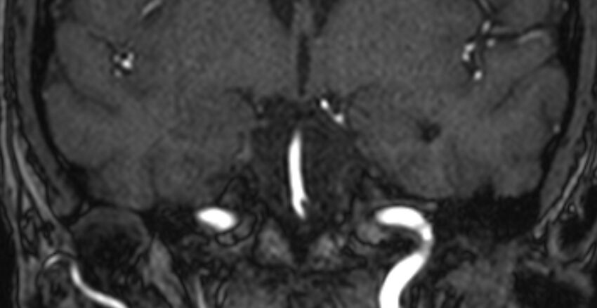 Basilar artery fenestration (Radiopaedia 74537-85455 Coronal MRA TOF 35).jpg