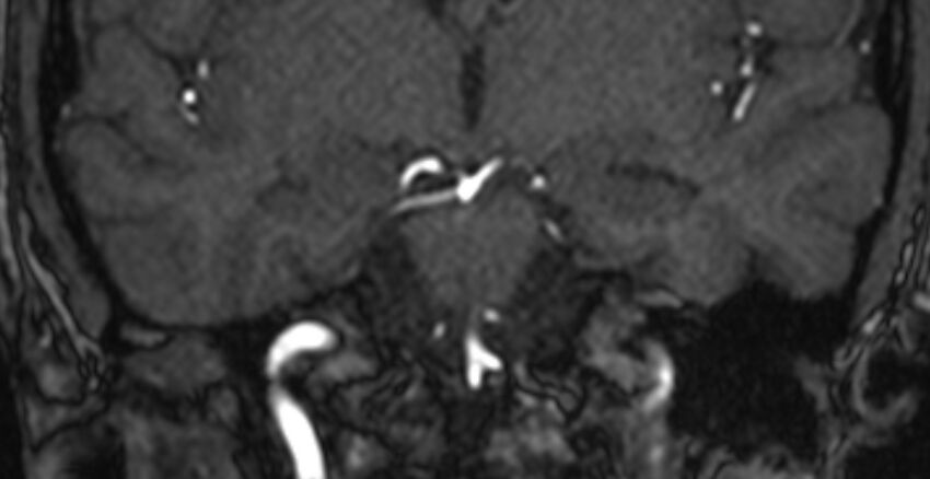 Basilar artery fenestration (Radiopaedia 74537-85455 Coronal MRA TOF 45).jpg