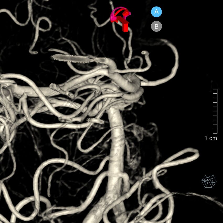 Basilar artery perforator aneurysm (Radiopaedia 82455-97734 3D view left VA 149).jpg
