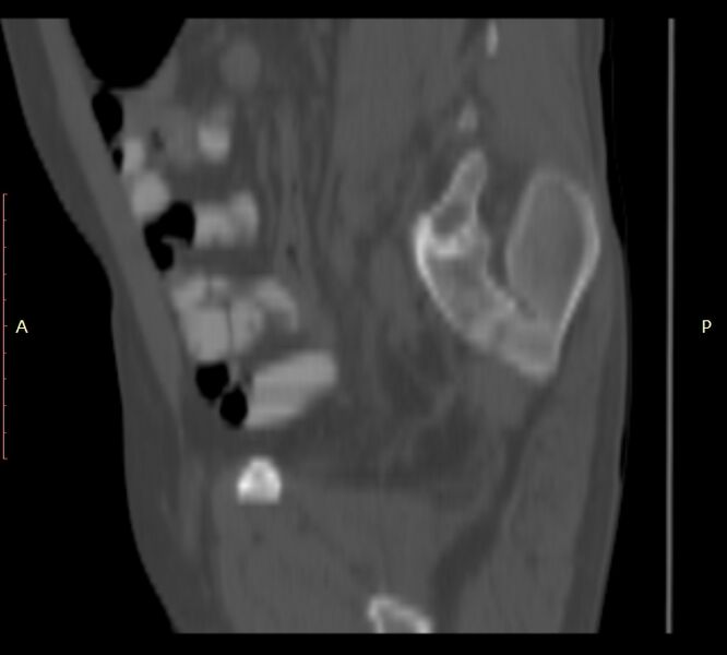 File:Bertolotti syndrome (Radiopaedia 58974-66235 Sagittal bone window 47).jpg
