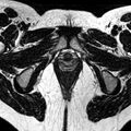 Bicornuate uterus (Radiopaedia 11104-11492 Axial T2 3).jpg