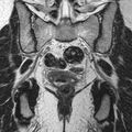 Bicornuate uterus (Radiopaedia 11104-11492 Coronal T2 21).jpg