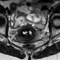 Bicornuate uterus (Radiopaedia 61974-70046 Axial T2 12).jpg