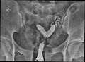Bicornuate vs septate uterus (Radiopaedia 62784-71120 B 1).jpg