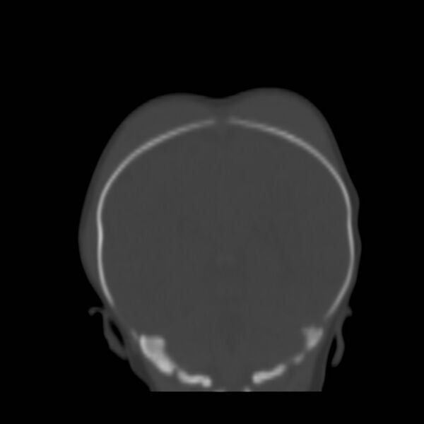 File:Bilateral cephalohematomas and subdural hematomas (Radiopaedia 26778-26929 Coronal bone window 20).jpg