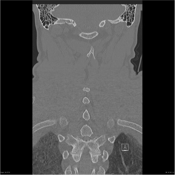 File:Bilateral cervical ribs (Radiopaedia 25868-26017 Coronal bone window 40).jpg