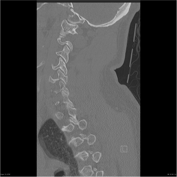 File:Bilateral cervical ribs (Radiopaedia 25868-26017 Sagittal bone window 51).jpg
