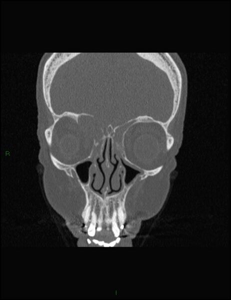 File:Bilateral frontal mucoceles (Radiopaedia 82352-96454 Coronal 110).jpg