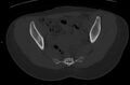 Bilateral mature cystic ovarian teratoma (Radiopaedia 88821-105592 Axial bone window 15).jpg