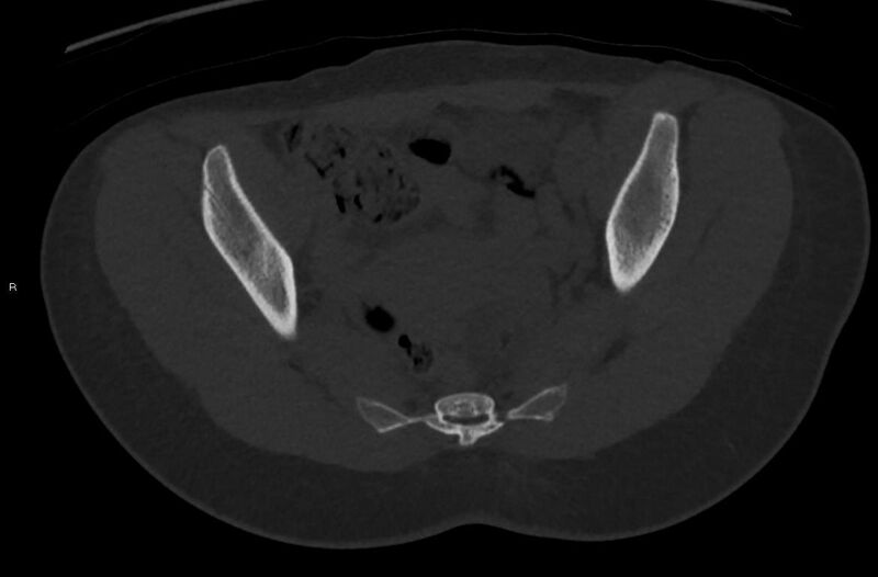 File:Bilateral mature cystic ovarian teratoma (Radiopaedia 88821-105592 Axial bone window 15).jpg