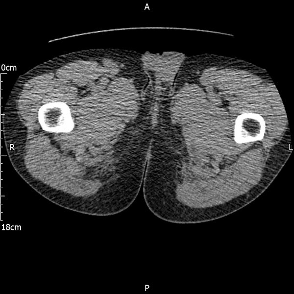 File:Bilateral medullary nephrocalcinosis with ureteric calculi (Radiopaedia 71269-81569 Axial non-contrast 153).jpg