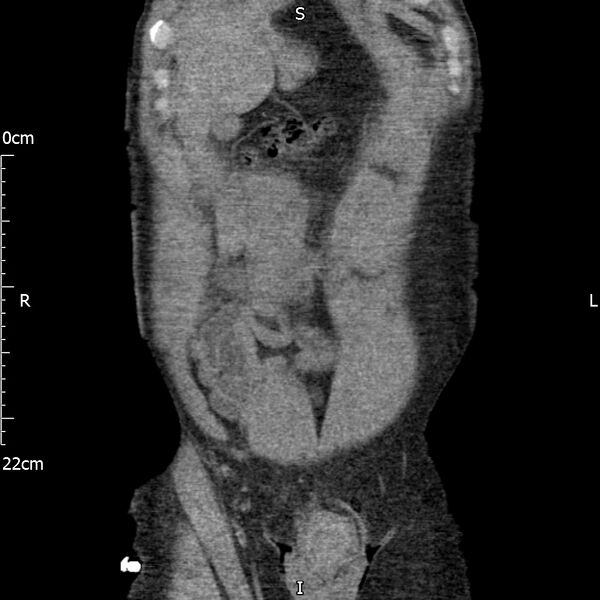 File:Bilateral medullary nephrocalcinosis with ureteric calculi (Radiopaedia 71269-81569 Coronal non-contrast 12).jpg