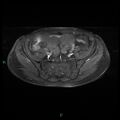 Bilateral ovarian fibroma (Radiopaedia 44568-48293 Axial T1 C+ fat sat 7).jpg