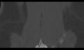 Bilateral pars defect (Radiopaedia 26691-26846 Coronal bone window 47).jpg