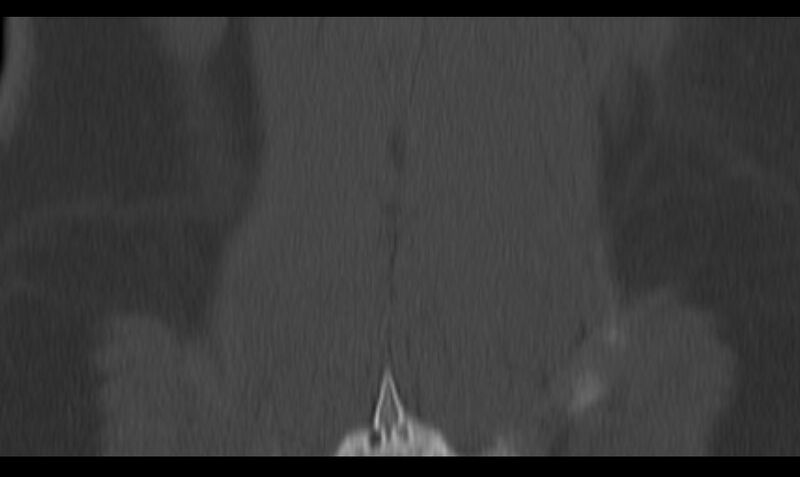 File:Bilateral pars defect (Radiopaedia 26691-26846 Coronal bone window 47).jpg