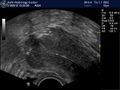 Bilateral tubal block and hydrosalpinx (Radiopaedia 23086-23117 A 6).jpg