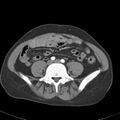 Biliary necrosis - liver transplant (Radiopaedia 21876-21845 A 45).jpg