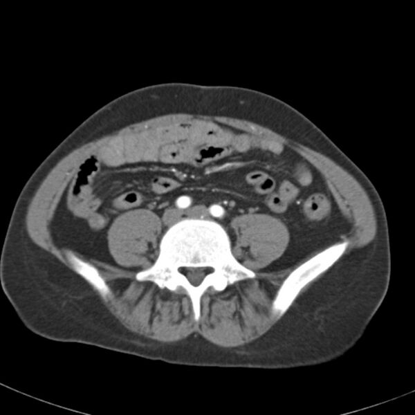 File:Biliary necrosis - liver transplant (Radiopaedia 21876-21845 A 45).jpg