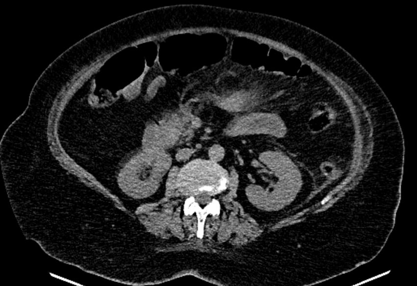 Biliary pancreatitis (Radiopaedia 72289-82823 Axial non-contrast 125).jpg
