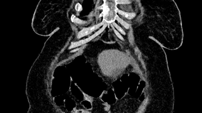 File:Biliary pancreatitis (Radiopaedia 72289-82823 Coronal non-contrast 13).jpg