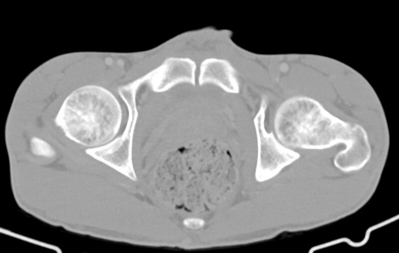 File:Blunt injury to the small bowel (Radiopaedia 74953-85987 Axial Wide 95).jpg