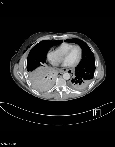 File:Boerhaave syndrome with tension pneumothorax (Radiopaedia 56794-63605 A 34).jpg