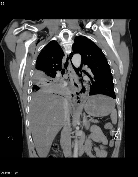 File:Boerhaave syndrome with tension pneumothorax (Radiopaedia 56794-63605 B 21).jpg