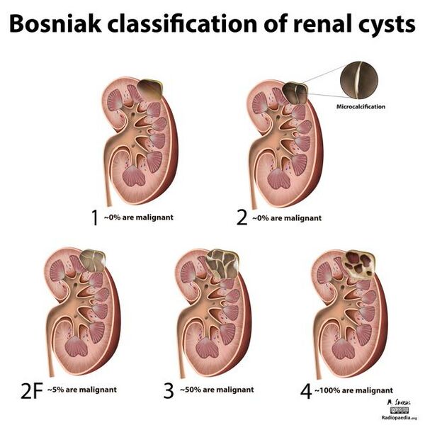 File:Bosniak cyst - type IV (Radiopaedia 23525-23628 A 1).jpg