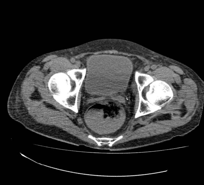 File:Bowel lymphoma complicated by bleeding after therapy (Radiopaedia 55601-62110 Axial non-contrast 76).jpg