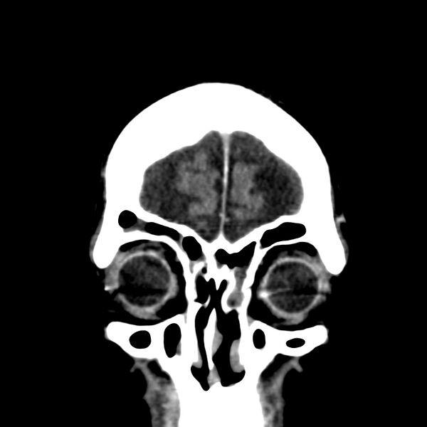 File:Brain Pantopaque remnants (Radiopaedia 78403-91048 Coronal non-contrast 9).jpg