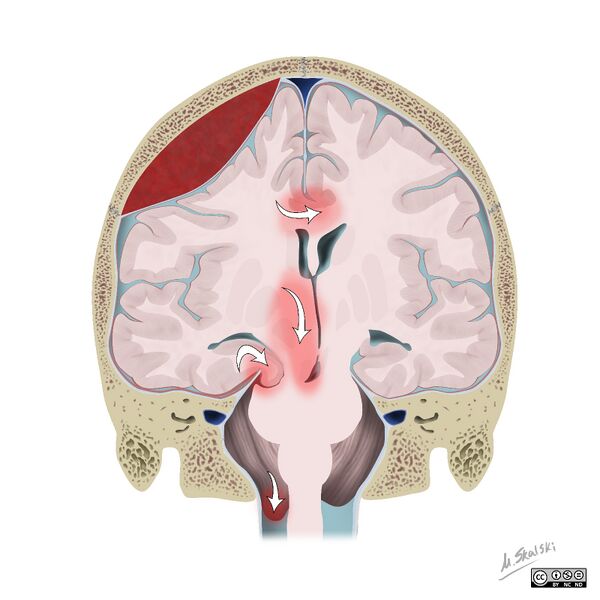 File:Brain herniation types (Radiopaedia 45683-49865 None 3).jpg