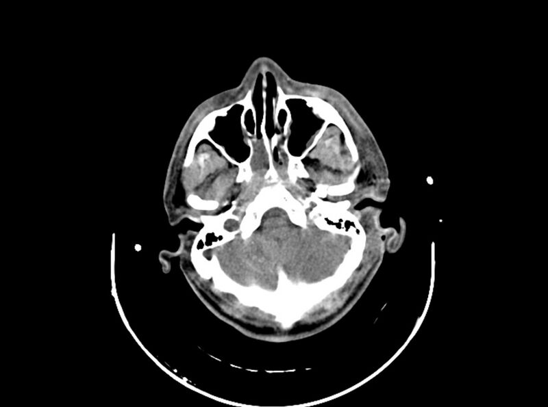 File:Brain injury by firearm projectile (Radiopaedia 82068-96087 B 54).jpg