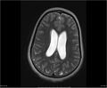 Brainstem glioma (Radiopaedia 21819-21775 Axial T2 26).jpg