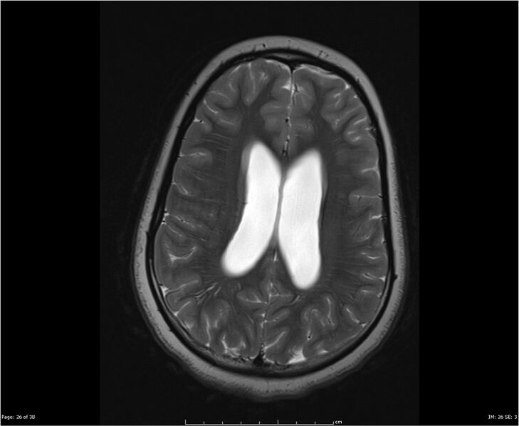 File:Brainstem glioma (Radiopaedia 21819-21775 Axial T2 26).jpg