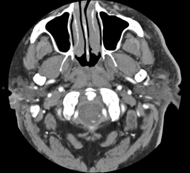 File:Brainstem hemorrhage (Radiopaedia 58794-66028 D 12).jpg