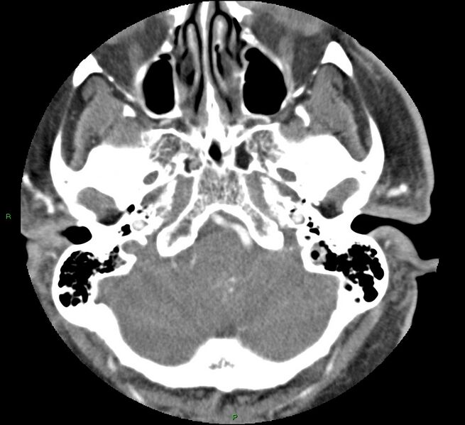 File:Brainstem hemorrhage (Radiopaedia 58794-66028 D 36).jpg