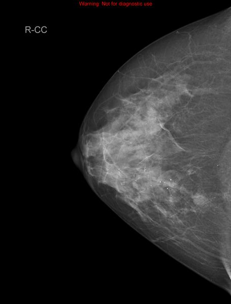 File:Breast carcinoma (multicentric multifocal in mammary Paget disease) (Radiopaedia 50966-56507 CC 1).jpg