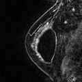 Breast implants - MRI (Radiopaedia 26864-27035 Sagittal T2 13).jpg
