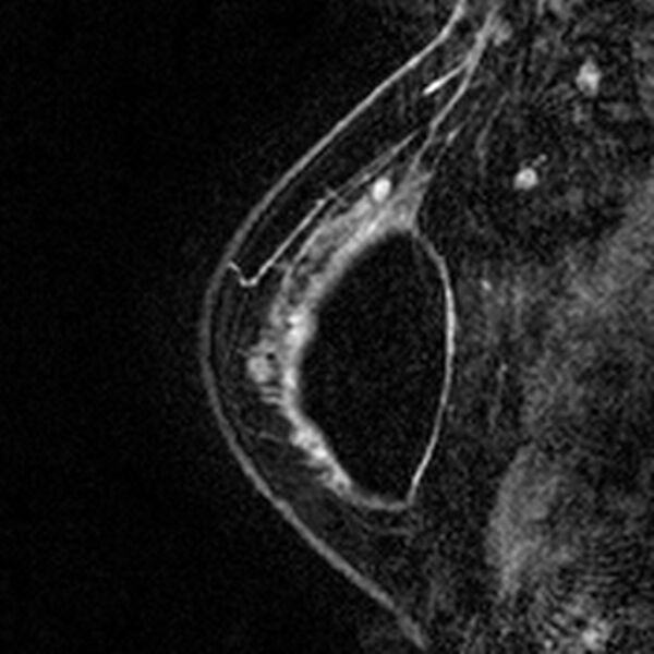 File:Breast implants - MRI (Radiopaedia 26864-27035 Sagittal T2 13).jpg